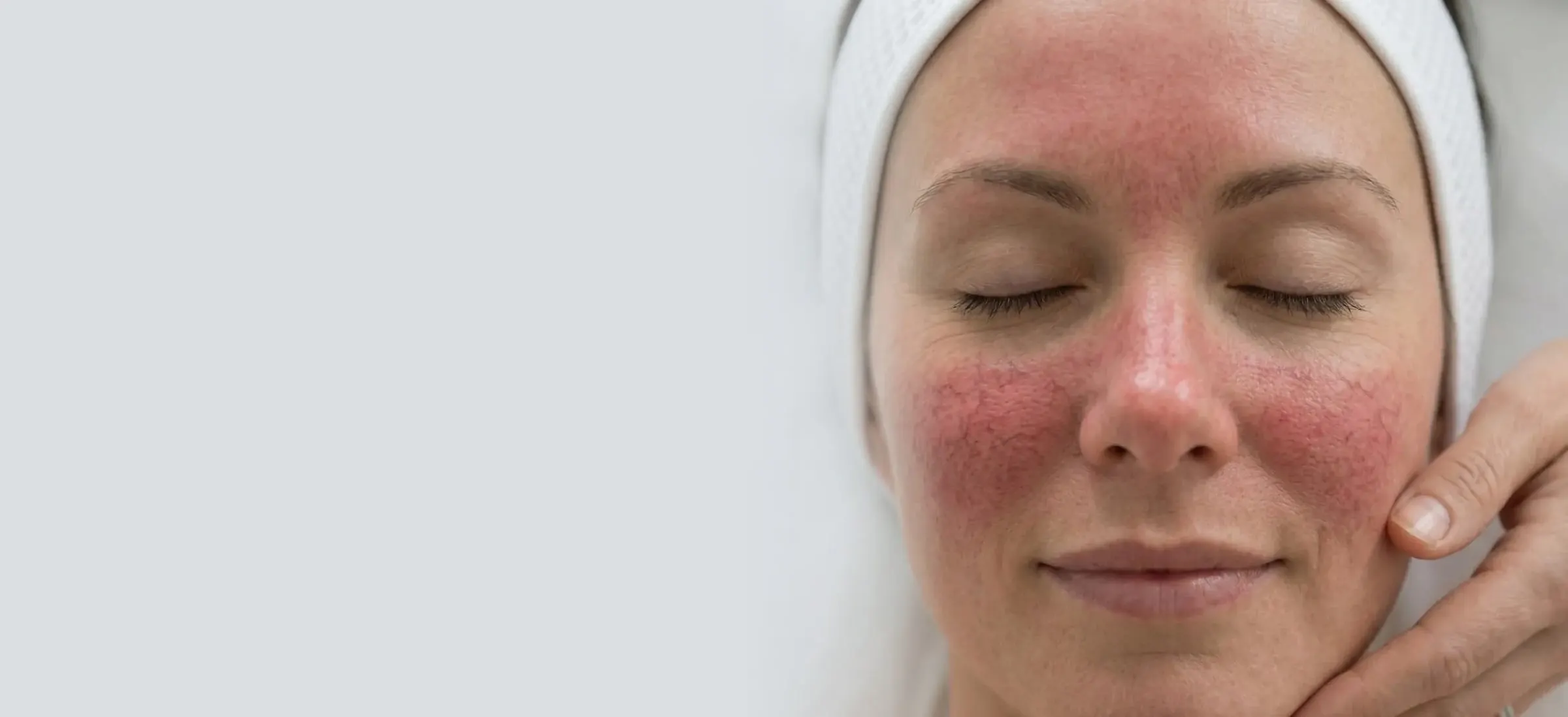Redness & Rosacea — treated at LEMON + LEIGH med spa in Boyd, TX