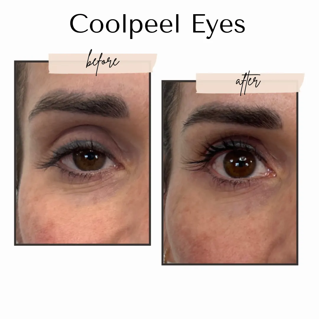 CoolPeel eyes before and after, fewer fine lines around the eye, LEMON + LEIGH Boyd TX