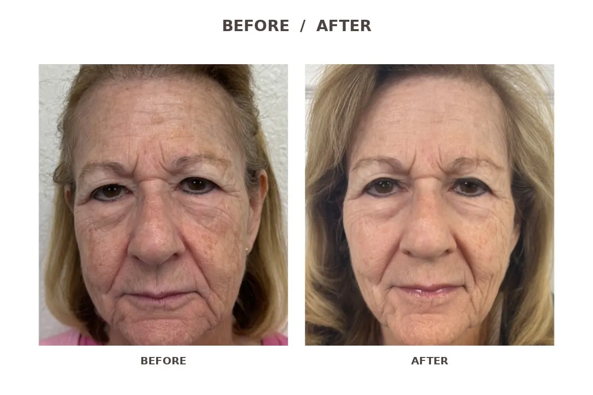 CoolPeel CO2 laser before and after, full face, improved tone and texture, LEMON + LEIGH Boyd TX