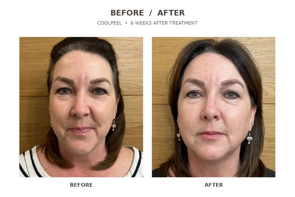CoolPeel CO2 laser before and 6 weeks after, full face, LEMON + LEIGH Boyd TX