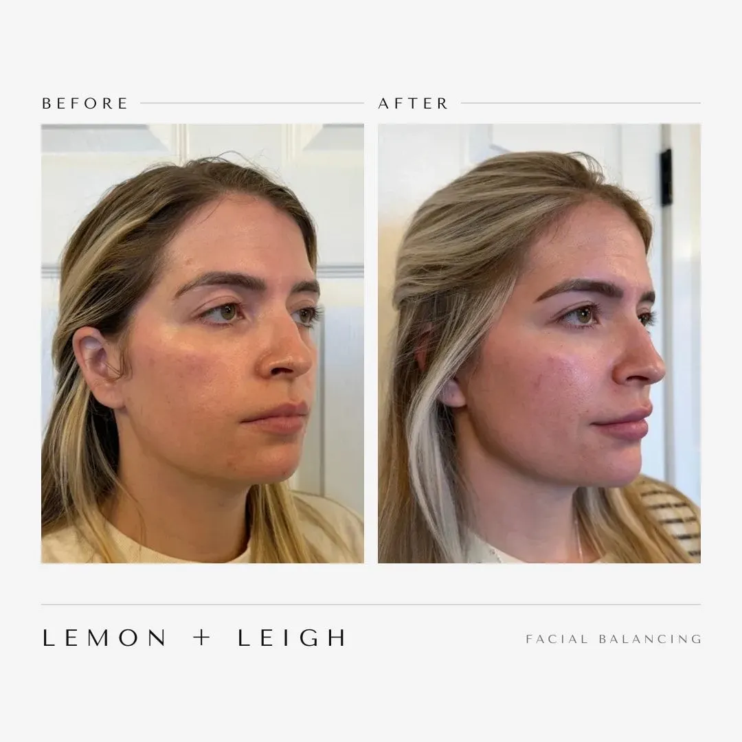 Facial balancing before and after at LEMON + LEIGH in Boyd, TX — client 1
