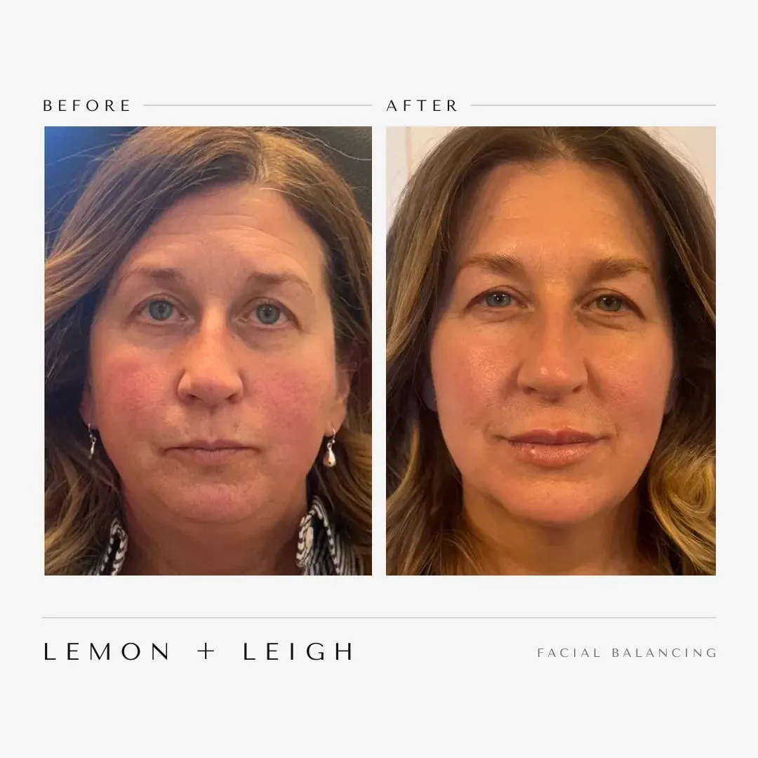 Facial balancing before and after at LEMON + LEIGH in Boyd, TX — client 2