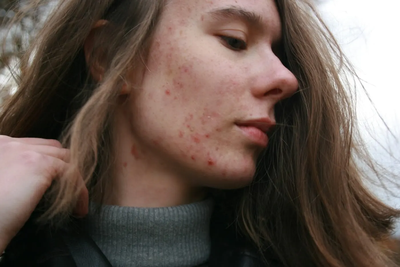 Acne & Breakouts treatment in Boyd, TX