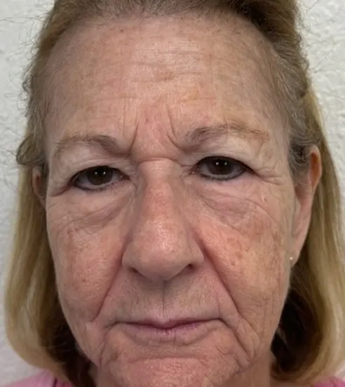 Fine Lines & Wrinkles — treated at LEMON + LEIGH med spa in Boyd, TX