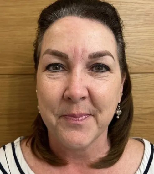 Sun Spots & Dark Spots treatment in Boyd, TX