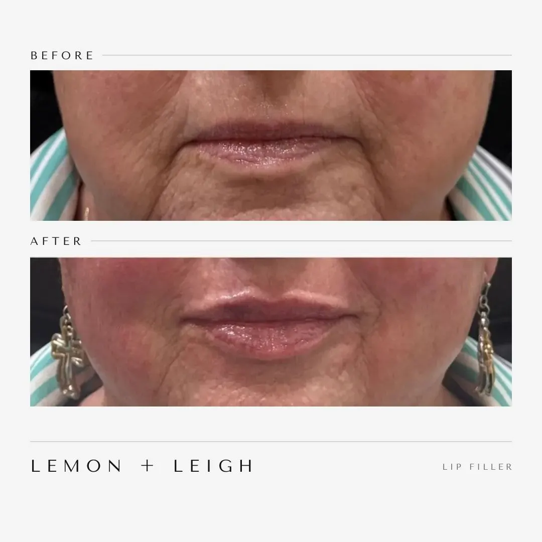 Lip filler before and after on a mature client, restored volume and smoother lip lines, LEMON + LEIGH Boyd TX
