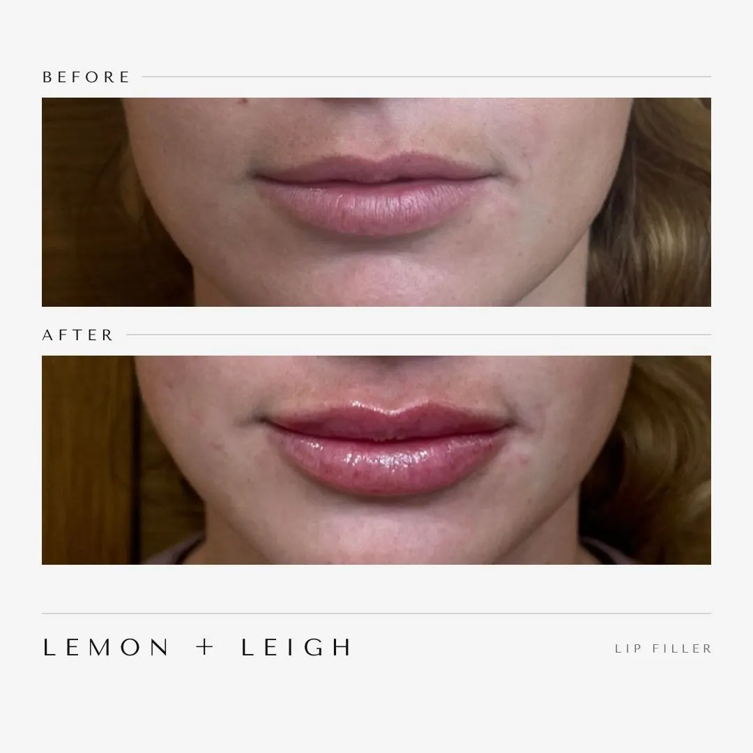 Lip filler before and after, front view, natural added volume, LEMON + LEIGH Boyd TX