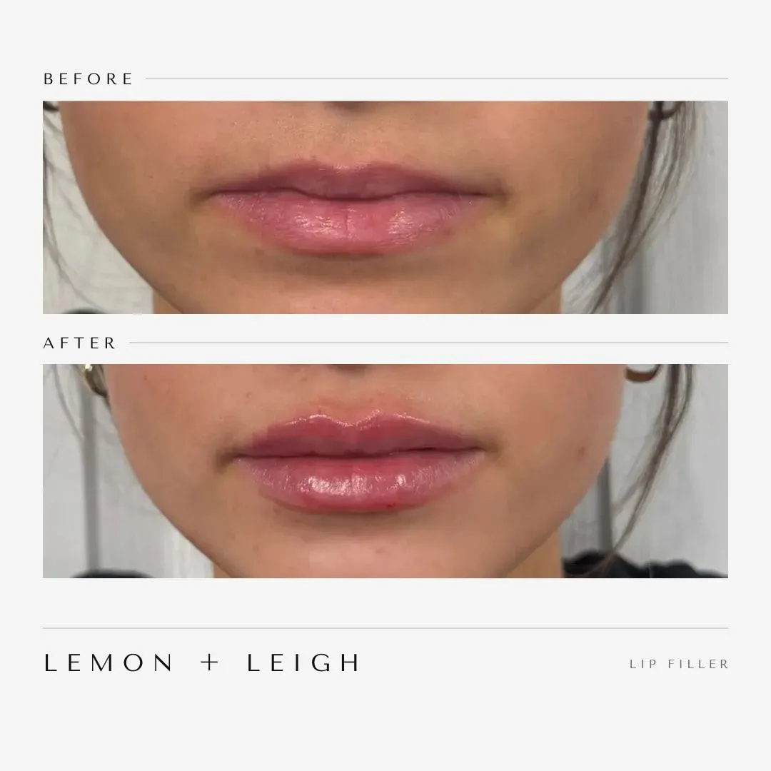 Subtle lip filler before and after, front view, LEMON + LEIGH Boyd TX