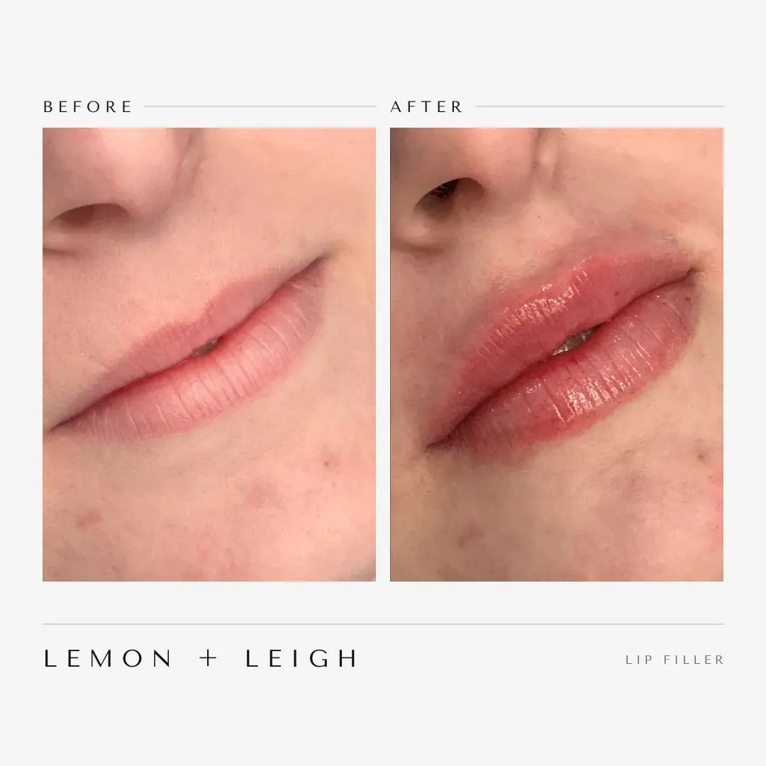 Lip filler before and after, side profile, fuller and hydrated lips, LEMON + LEIGH Boyd TX