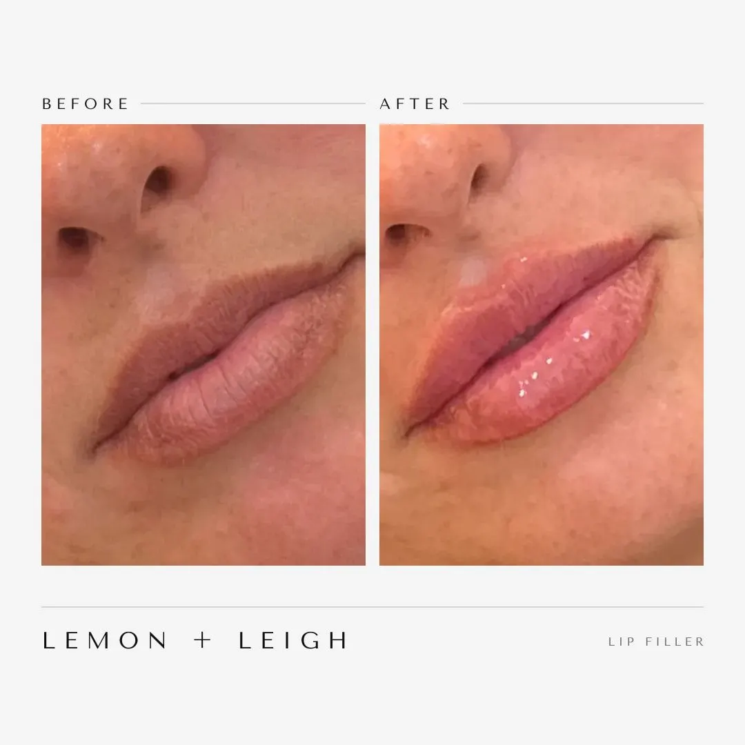 Lip filler before and after, side view, defined lip border, LEMON + LEIGH Boyd TX