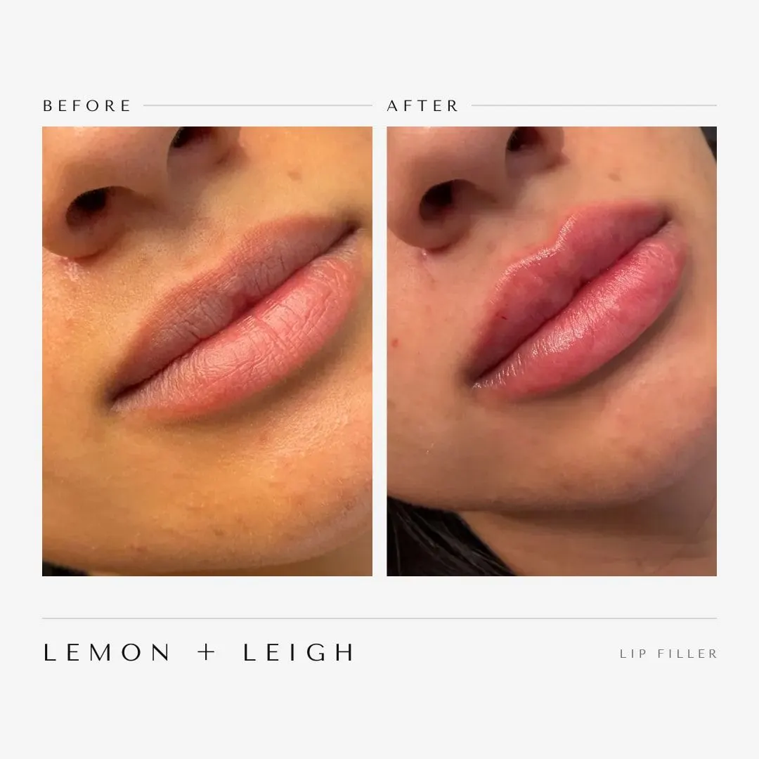 Lip filler before and after, side view, fuller plush lips, LEMON + LEIGH Boyd TX