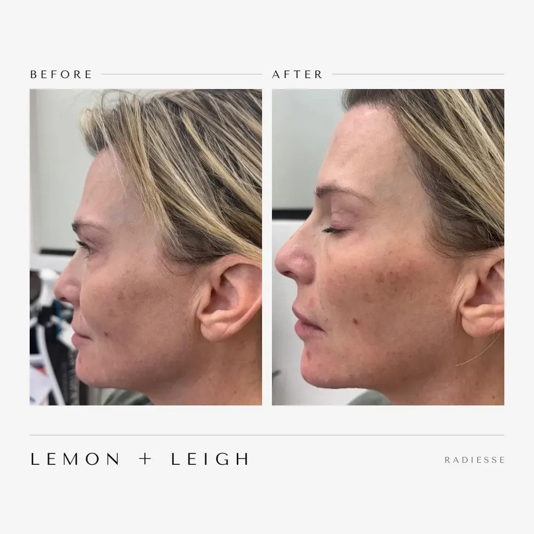 Radiesse before and after at LEMON + LEIGH in Boyd, TX — client 1