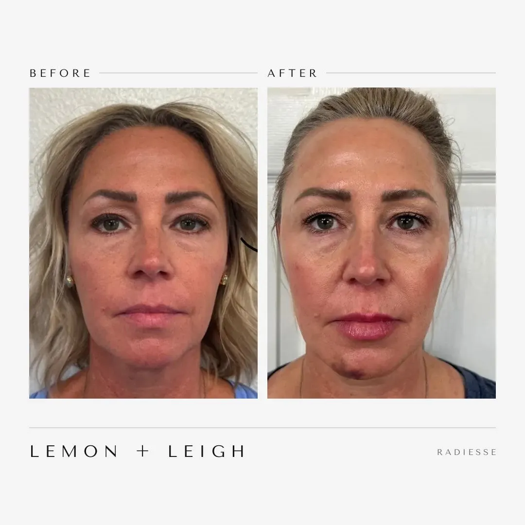Radiesse before and after at LEMON + LEIGH in Boyd, TX — client 2