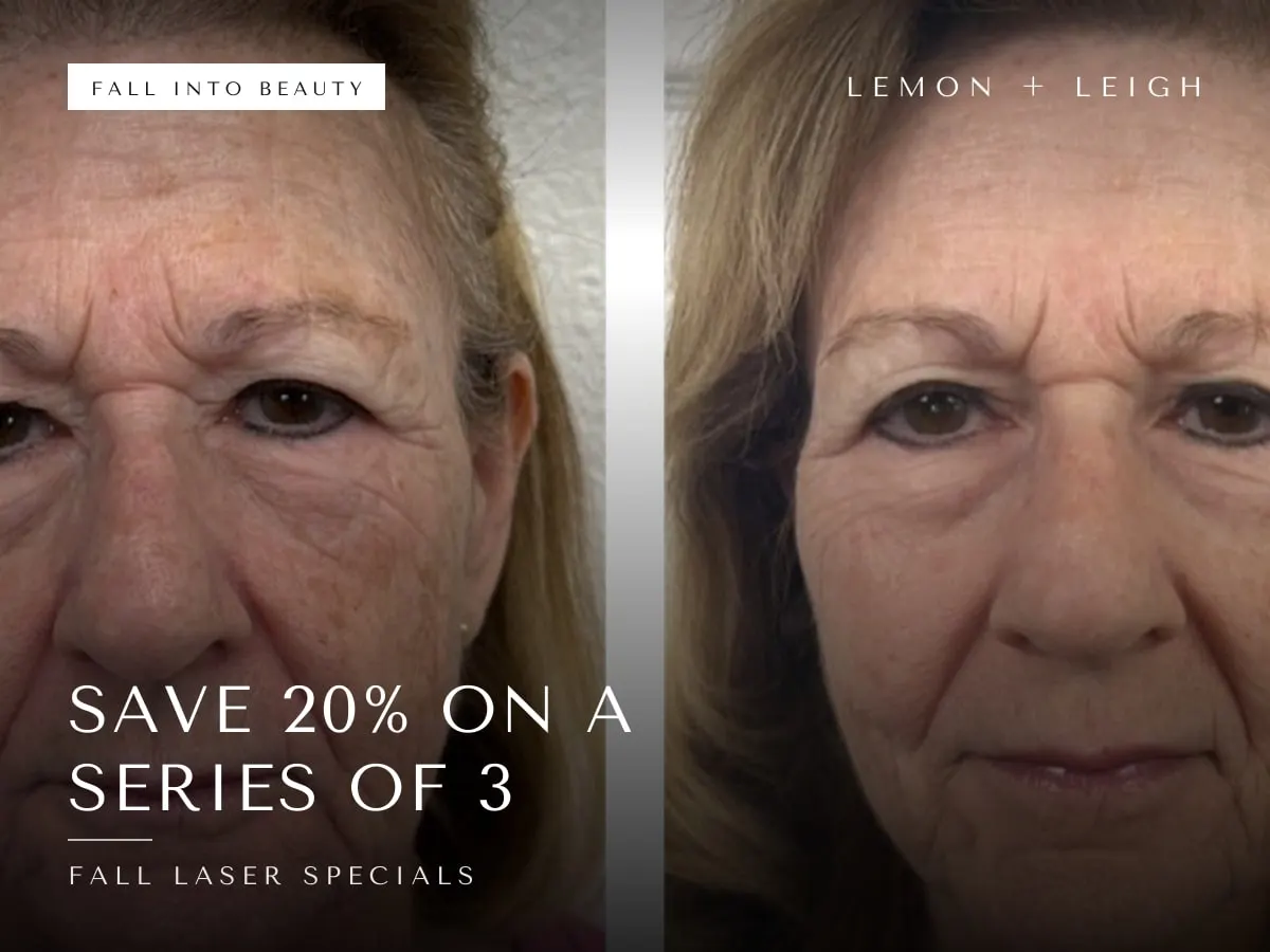 Fall Laser Specials special at LEMON + LEIGH: Save 20% — Series of 3